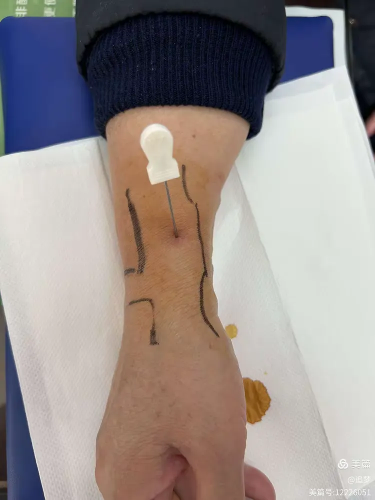 小针刀治疗桡骨茎突狭窄性腱鞘炎